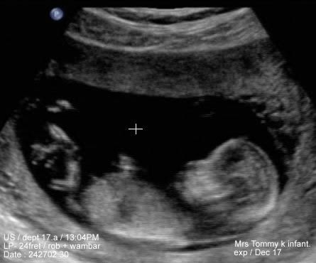 BabyUltrasound.jpg